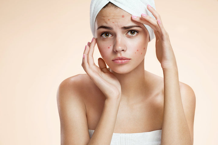 ACNE: M.A.D SKINCARE’S ROADMAP TO CLEARER SKIN