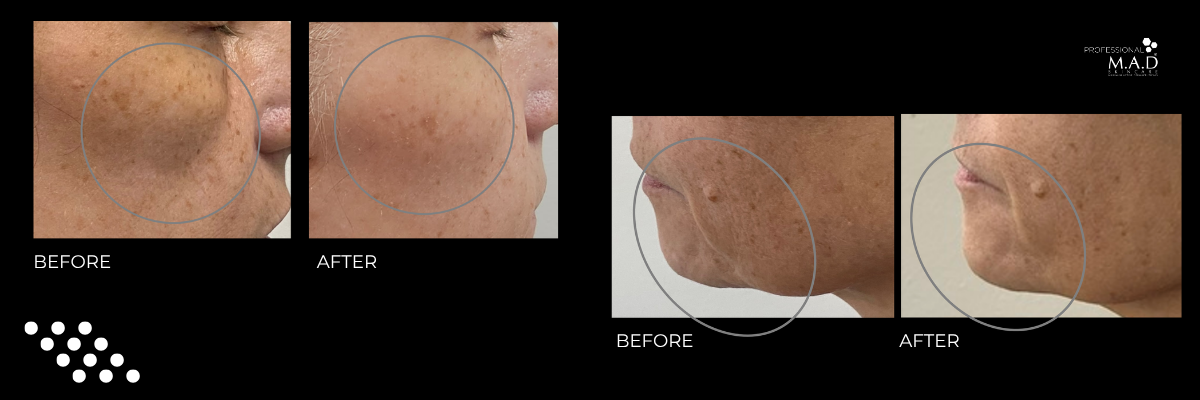 The M.A.D Skincare Advanced CARBONETIX/SYNPLA Growth Factor Facial: See the Results!
