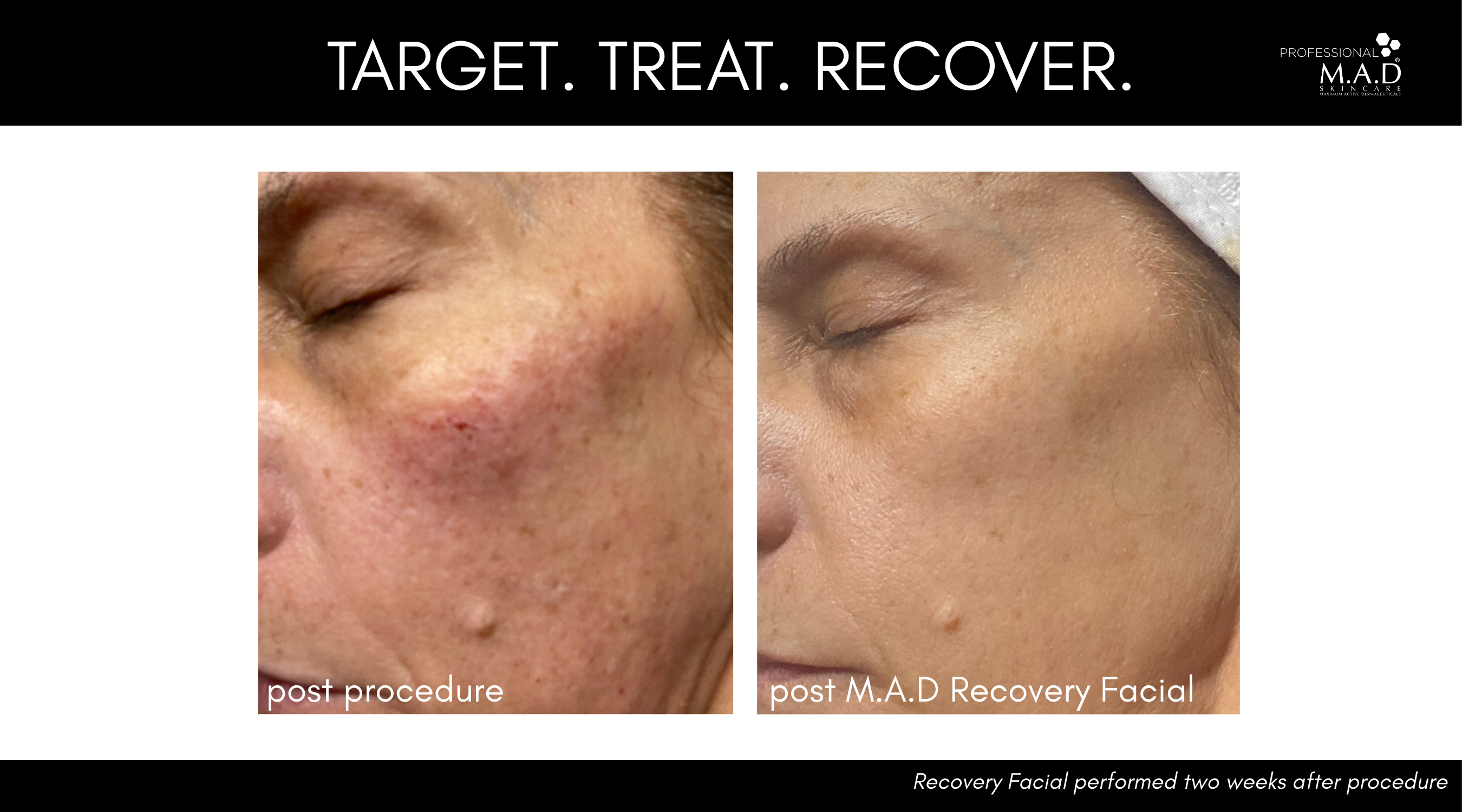M.A.D Skincare Recovery Facial: Post-Procedure Care for Optimal Results