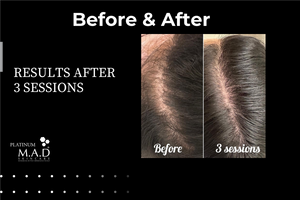 SYNPLA Anagen Growth Factor Serum GF 3.0/HLA 3.0