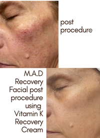4oz PRO Vitamin K Recovery Cream