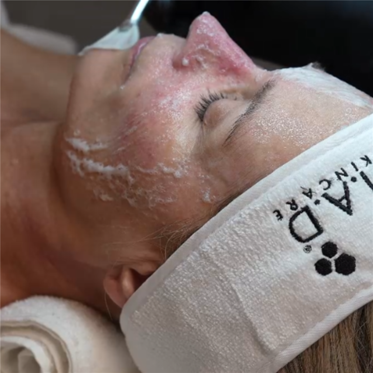 CARBONETIX Skin Rejuvenating System