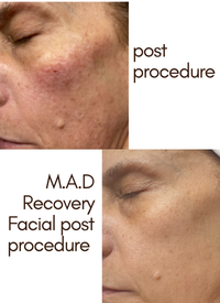 M.A.D Skincare Recovery Facial